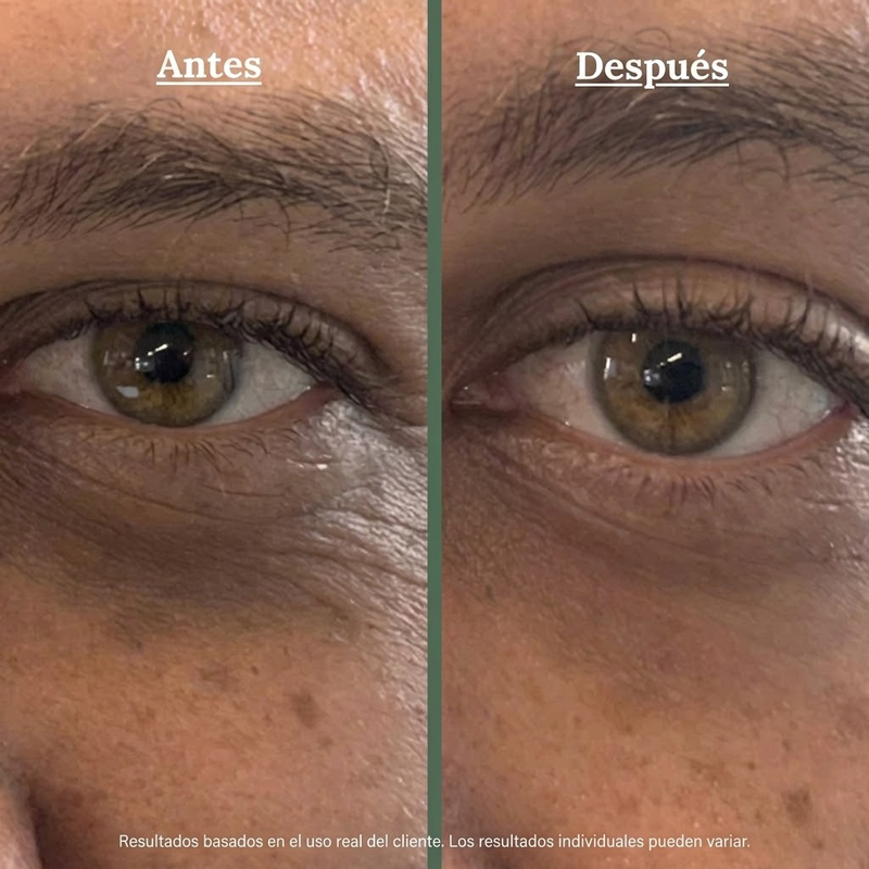 Resultado Antes y Después Vanity Pose