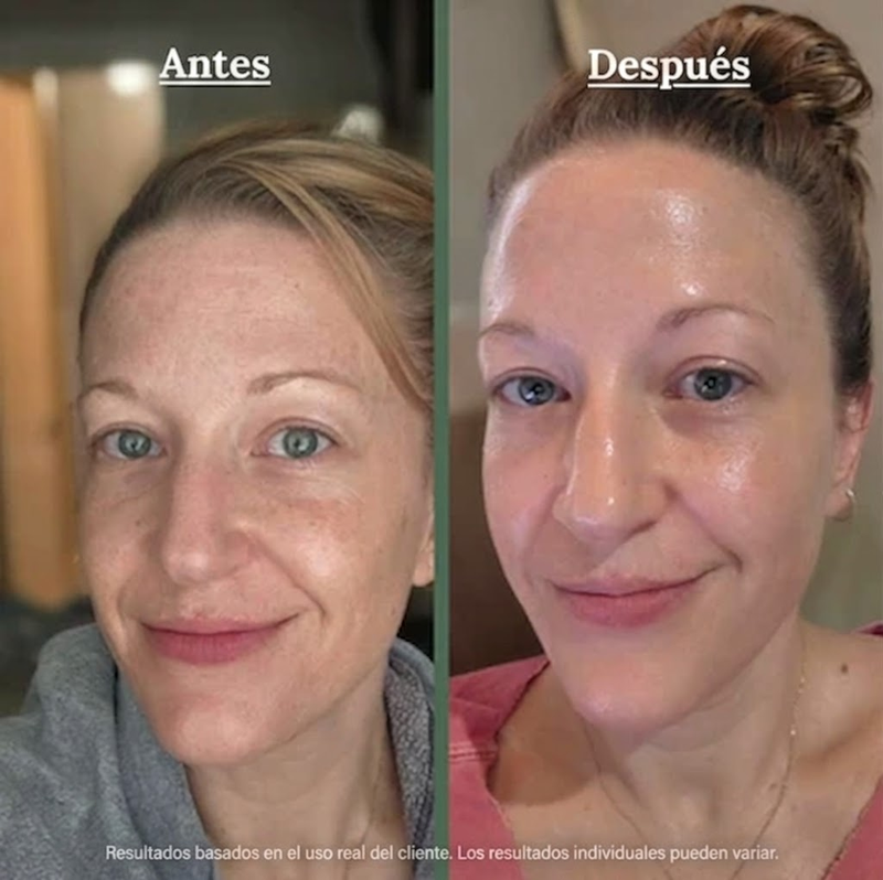 Resultado Antes y Después Vanity Pose